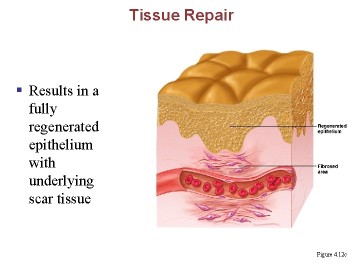 Tissue Repair § Results in a fully regenerated epithelium with underlying scar tissue Figure