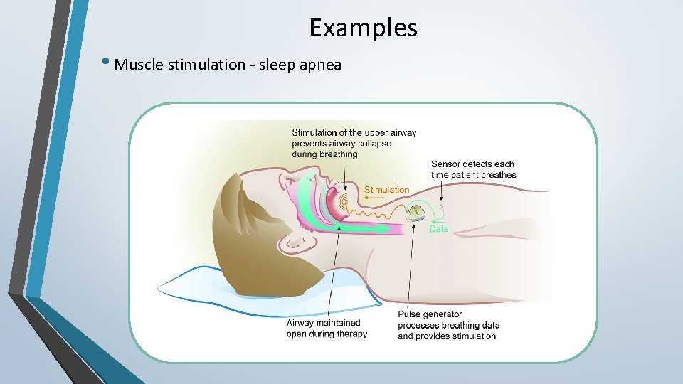 Examples • Muscle stimulation - sleep apnea 