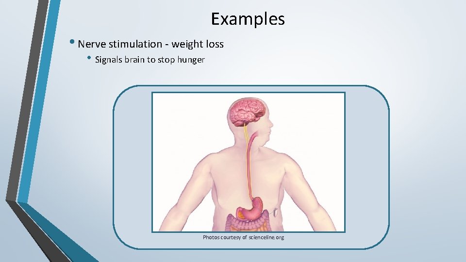 Examples • Nerve stimulation - weight loss • Signals brain to stop hunger Photos