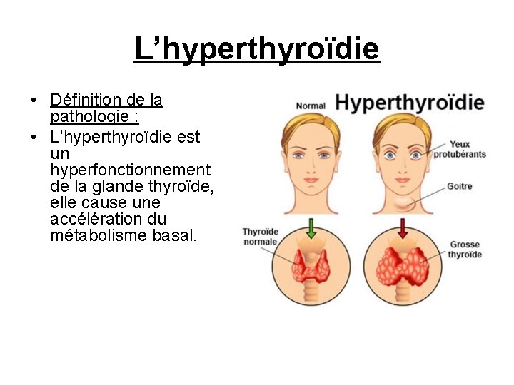 L’hyperthyroïdie • Définition de la pathologie : • L’hyperthyroïdie est un hyperfonctionnement de la