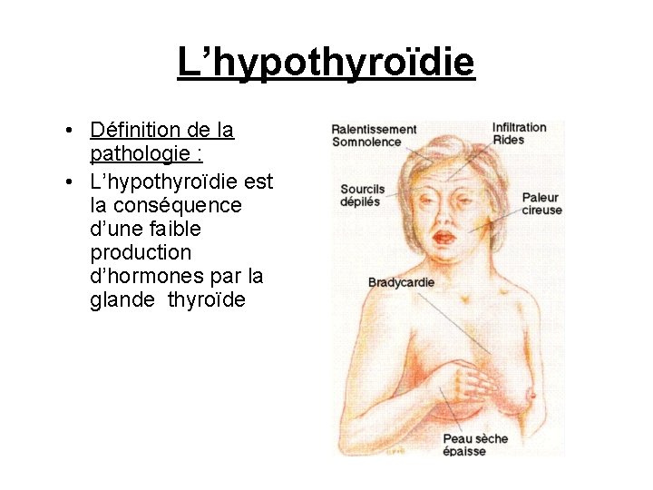 L’hypothyroïdie • Définition de la pathologie : • L’hypothyroïdie est la conséquence d’une faible