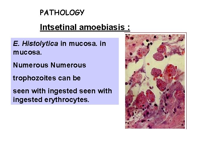 PATHOLOGY Intsetinal amoebiasis : E. Histolytica in mucosa. Numerous trophozoites can be seen with