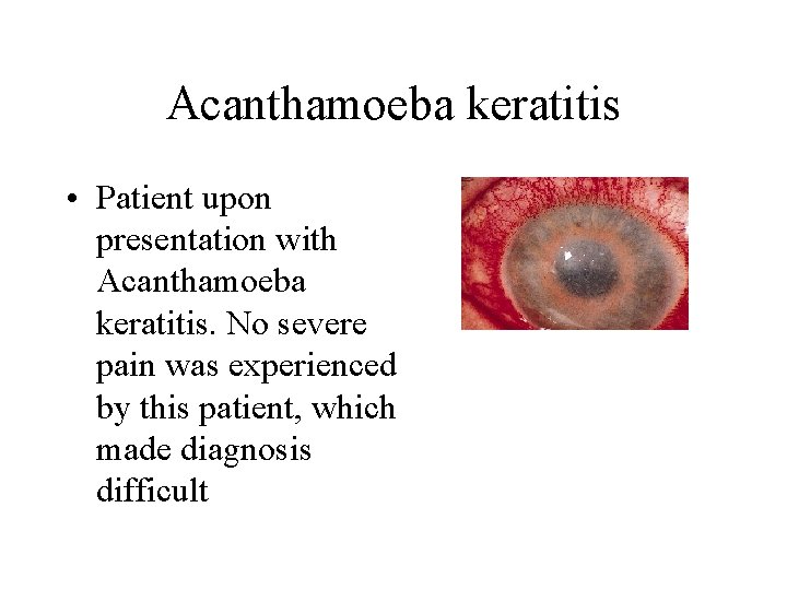 Acanthamoeba keratitis • Patient upon presentation with Acanthamoeba keratitis. No severe pain was experienced