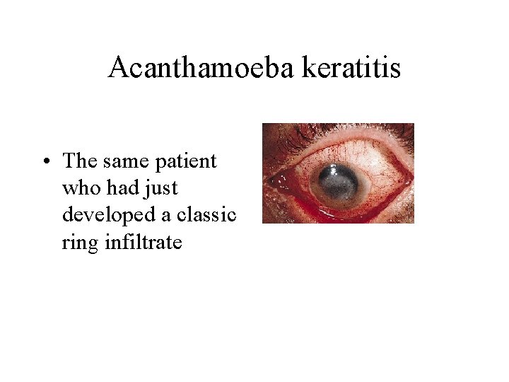 Acanthamoeba keratitis • The same patient who had just developed a classic ring infiltrate