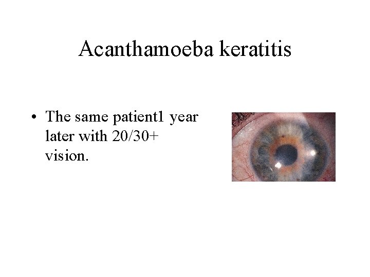 Acanthamoeba keratitis • The same patient 1 year later with 20/30+ vision. 