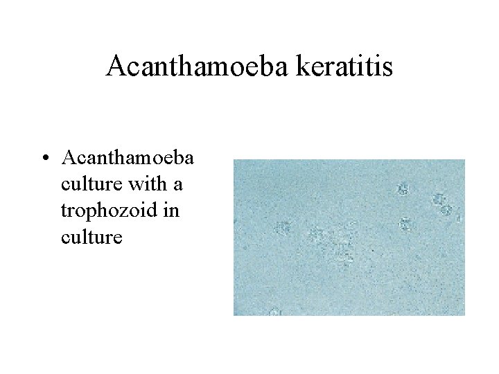 Acanthamoeba keratitis • Acanthamoeba culture with a trophozoid in culture 