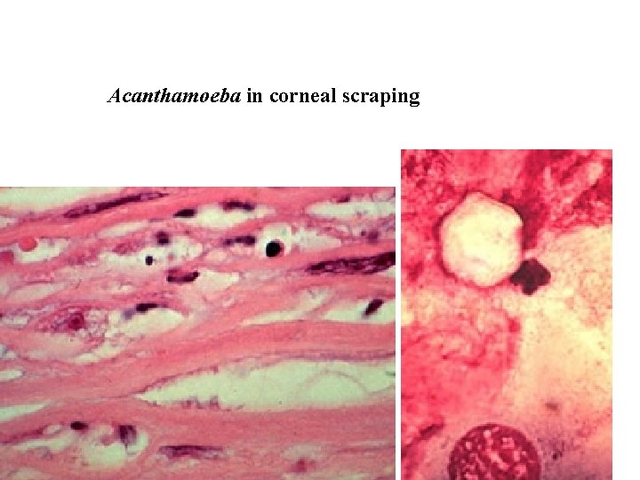 Acanthamoeba in corneal scraping 
