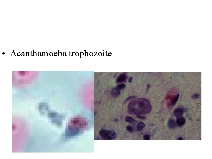  • Acanthamoeba trophozoite 