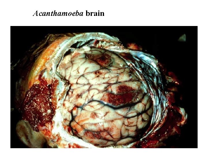 Acanthamoeba brain 