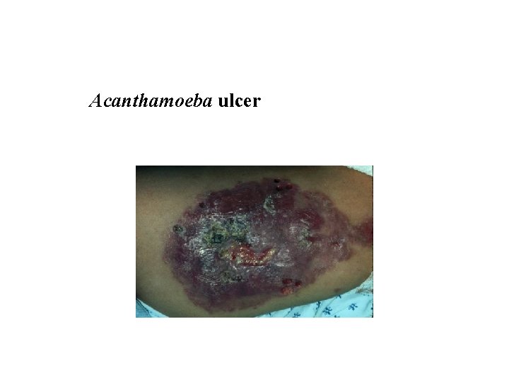 Acanthamoeba ulcer 
