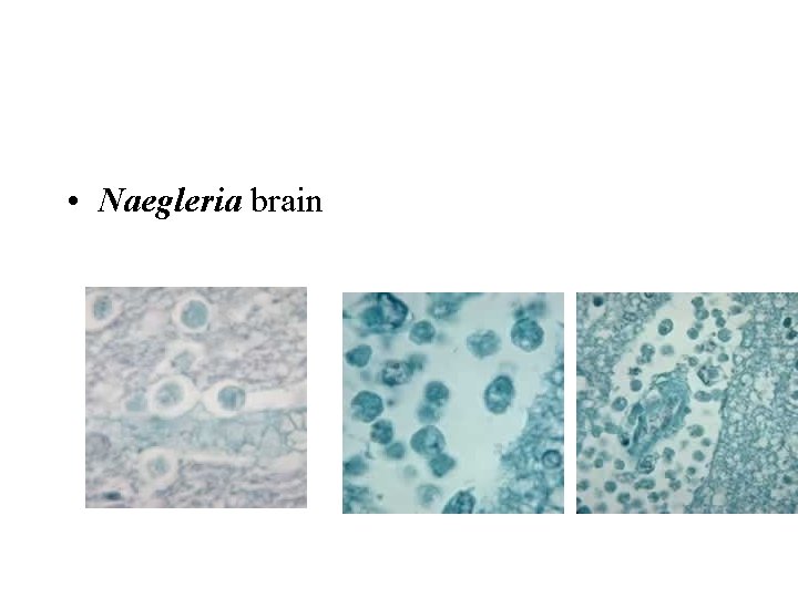  • Naegleria brain 