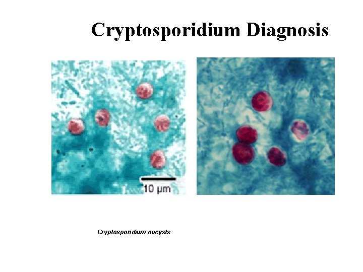 Cryptosporidium Diagnosis Cryptosporidium oocysts 