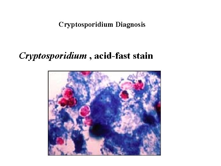 Cryptosporidium Diagnosis Cryptosporidium , acid-fast stain 