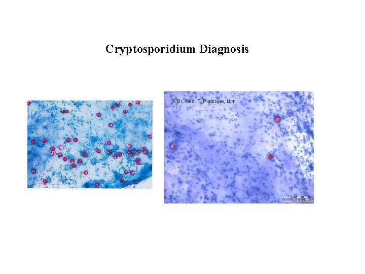 Cryptosporidium Diagnosis 
