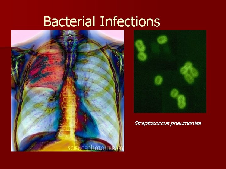 Bacterial Infections Streptococcus pneumoniae 