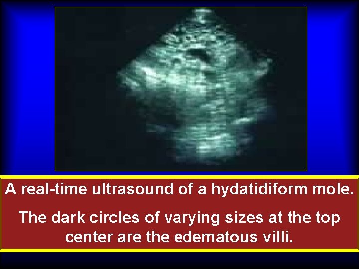 A real-time ultrasound of a hydatidiform mole. The dark circles of varying sizes at