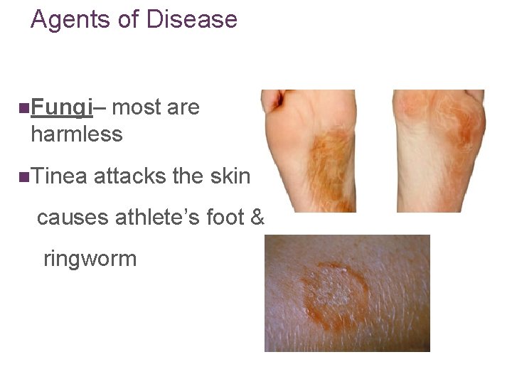 Agents of Disease n. Fungi– most are harmless n. Tinea attacks the skin causes