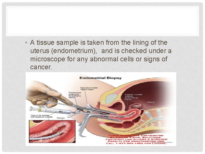  • A tissue sample is taken from the lining of the uterus (endometrium),