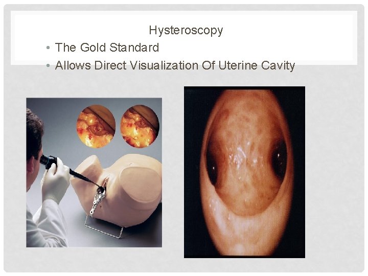 Hysteroscopy • The Gold Standard • Allows Direct Visualization Of Uterine Cavity 