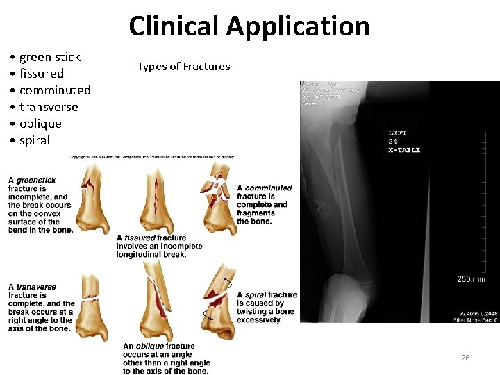 Clinical Application • green stick • fissured • comminuted • transverse • oblique •
