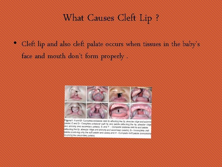 What Causes Cleft Lip ? • Cleft lip and also cleft palate occurs when