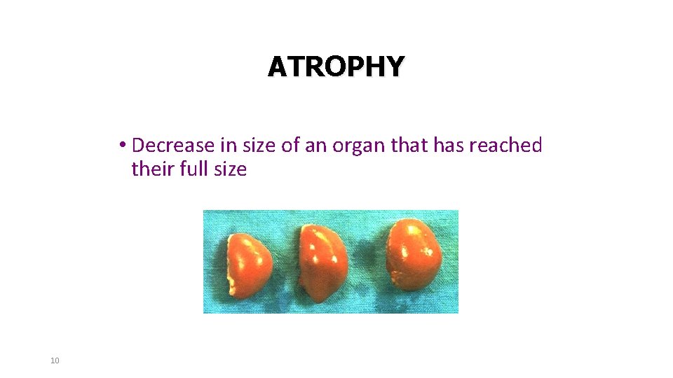 ATROPHY • Decrease in size of an organ that has reached their full size