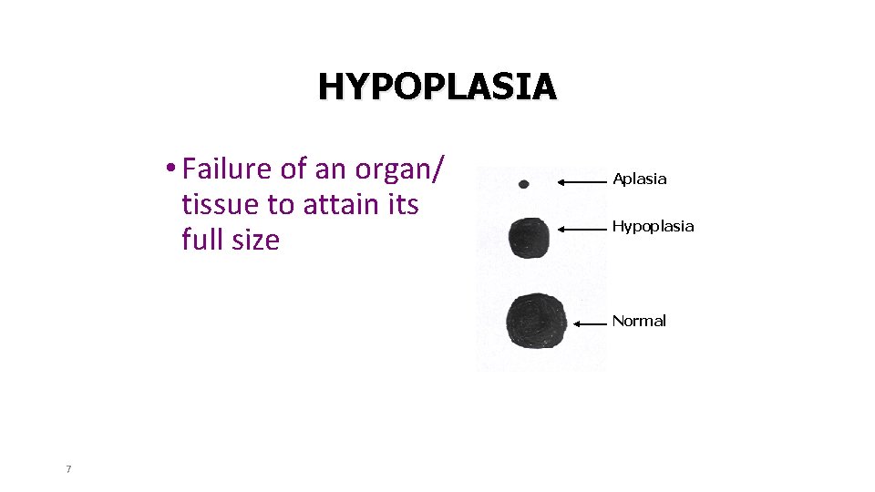 HYPOPLASIA • Failure of an organ/ tissue to attain its full size Aplasia Hypoplasia