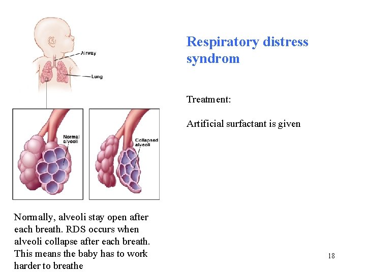 Respiratory distress syndrom Treatment: Artificial surfactant is given Normally, alveoli stay open after each