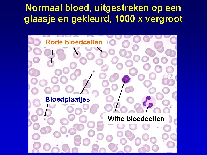 Normaal bloed, uitgestreken op een glaasje en gekleurd, 1000 x vergroot Rode bloedcellen Bloedplaatjes