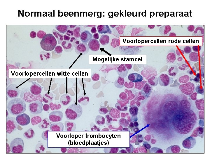 Normaal beenmerg: gekleurd preparaat Voorlopercellen rode cellen Mogelijke stamcel Voorlopercellen witte cellen Voorloper trombocyten