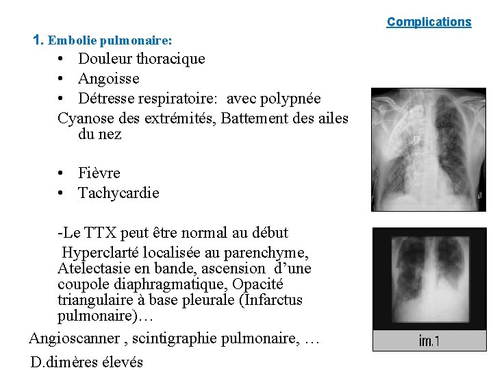 Complications 1. Embolie pulmonaire: • Douleur thoracique • Angoisse • Détresse respiratoire: avec polypnée