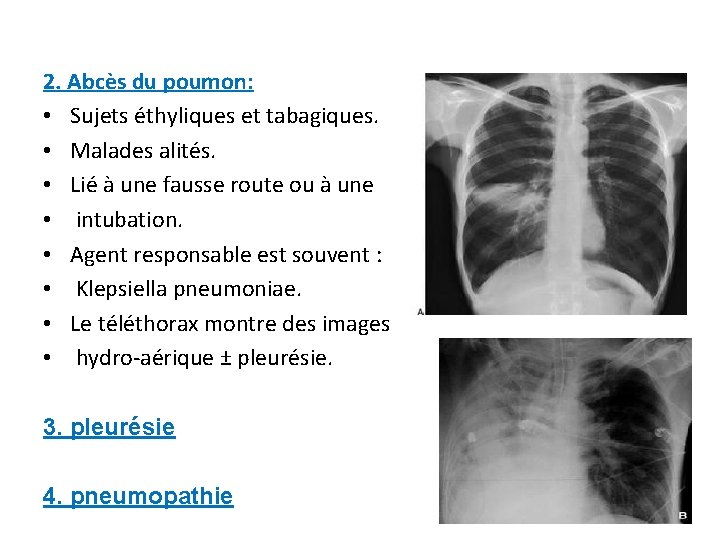2. Abcès du poumon: • Sujets éthyliques et tabagiques. • Malades alités. • Lié