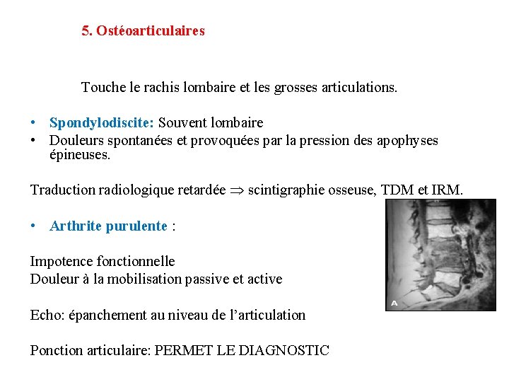 5. Ostéoarticulaires Touche le rachis lombaire et les grosses articulations. • Spondylodiscite: Souvent lombaire