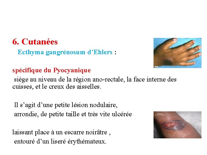 6. Cutanées Ecthyma gangrénosum d’Ehlers : spécifique du Pyocyanique siège au niveau de la