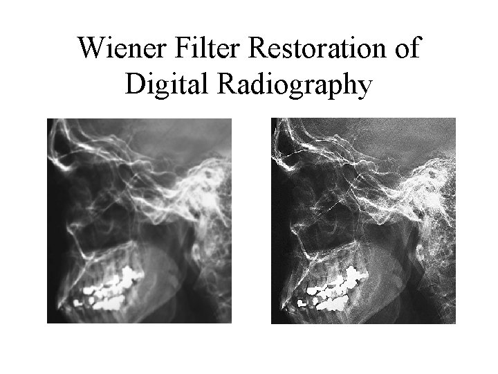 Wiener Filter Restoration of Digital Radiography 