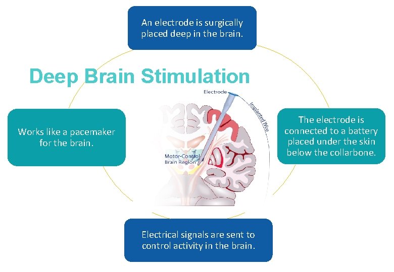 An electrode is surgically placed deep in the brain. Deep Brain Stimulation The electrode