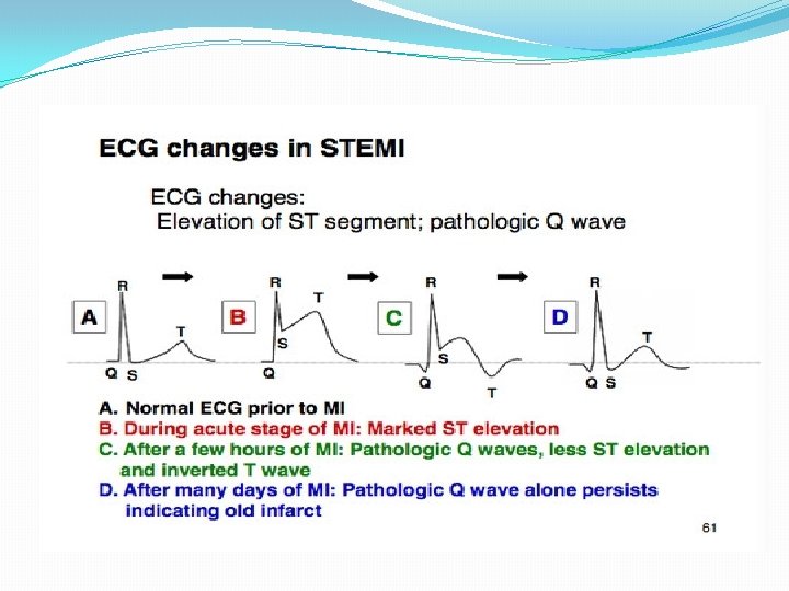 ECG 
