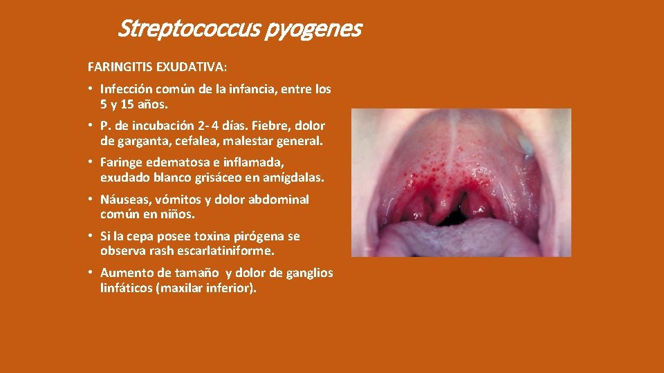 Streptococcus pyogenes FARINGITIS EXUDATIVA: • Infección común de la infancia, entre los 5 y