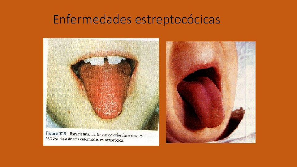Enfermedades estreptocócicas 