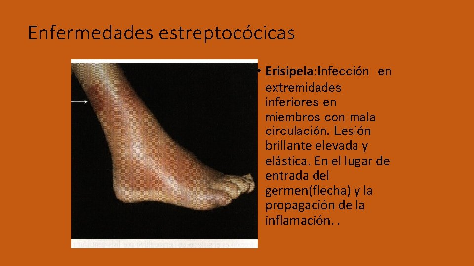 Enfermedades estreptocócicas • Erisipela: Infección en extremidades inferiores en miembros con mala circulación. Lesión