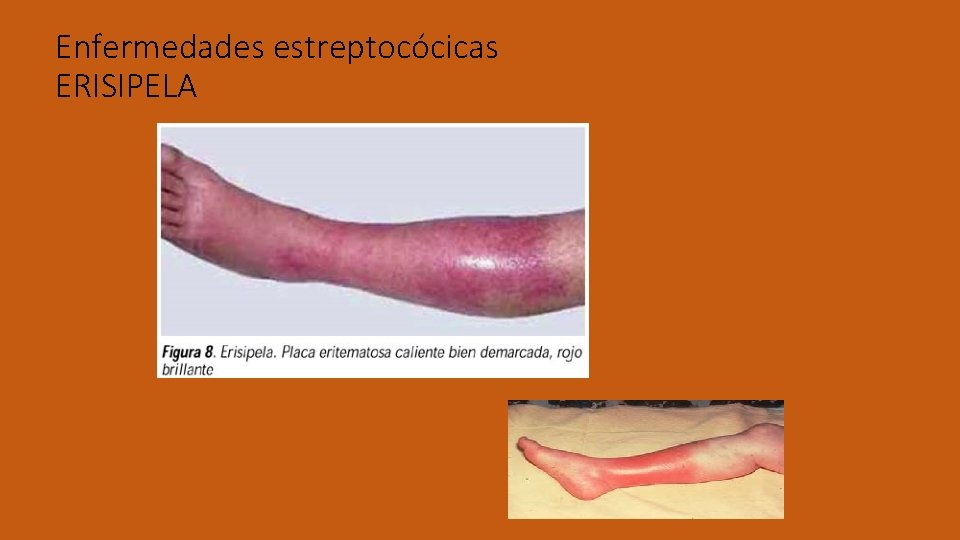 Enfermedades estreptocócicas ERISIPELA 