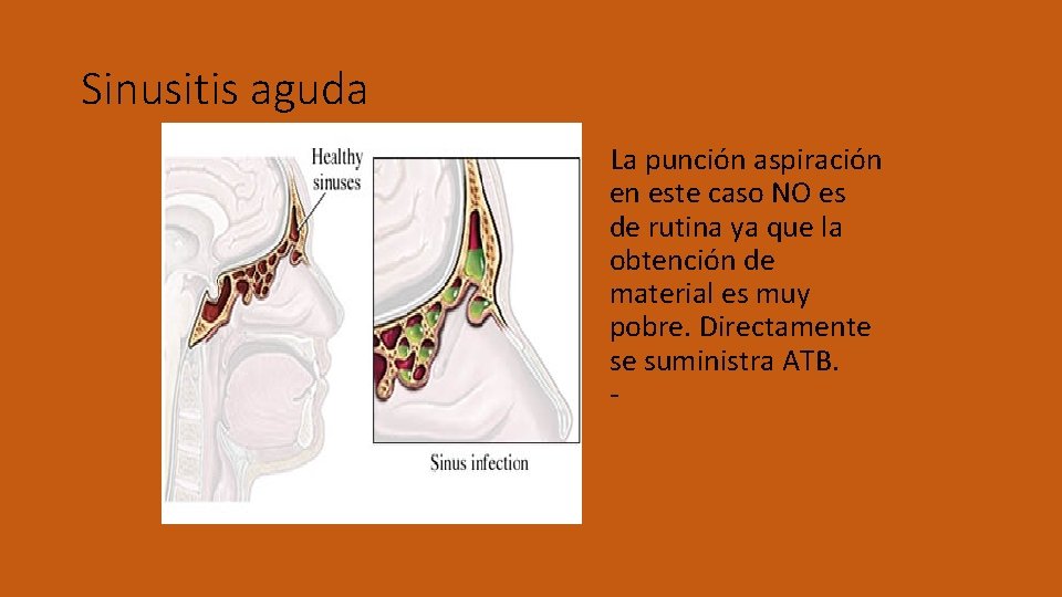Sinusitis aguda La punción aspiración en este caso NO es de rutina ya que