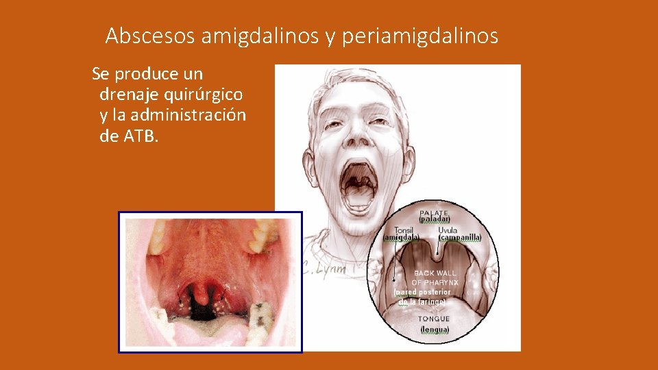 Abscesos amigdalinos y periamigdalinos Se produce un drenaje quirúrgico y la administración de ATB.