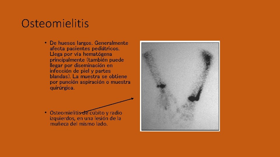 Osteomielitis • De huesos largos. Generalmente afecta pacientes pediátricos. Llega por vía hematógena principalmente