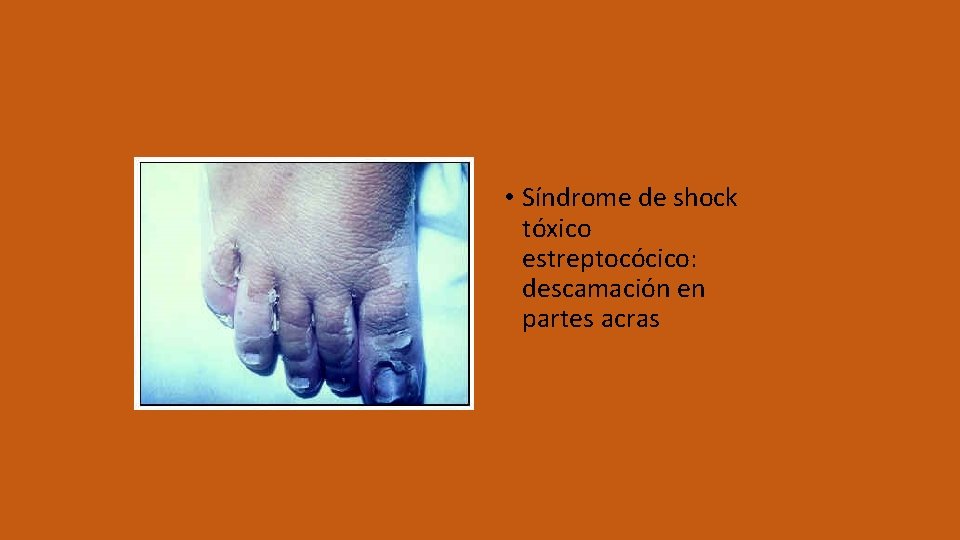  • Síndrome de shock tóxico estreptocócico: descamación en partes acras 