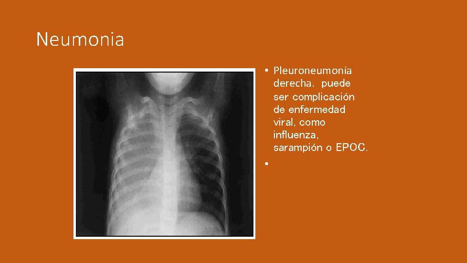 Neumonia • Pleuroneumonía derecha. puede ser complicación de enfermedad viral, como influenza, sarampión o