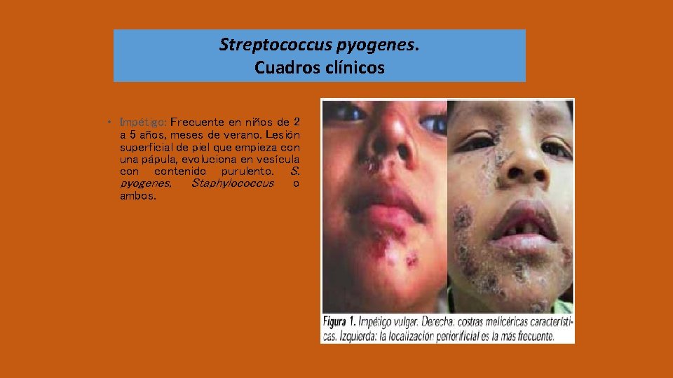 Streptococcus pyogenes. Cuadros clínicos • Impétigo: Frecuente en niños de 2 a 5 años,