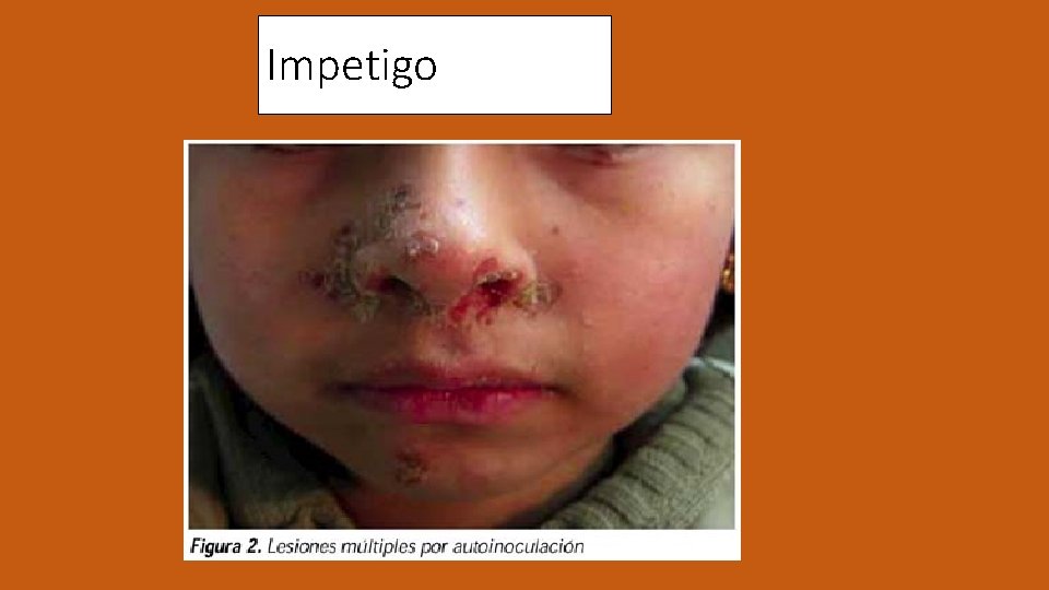 Impetigo 