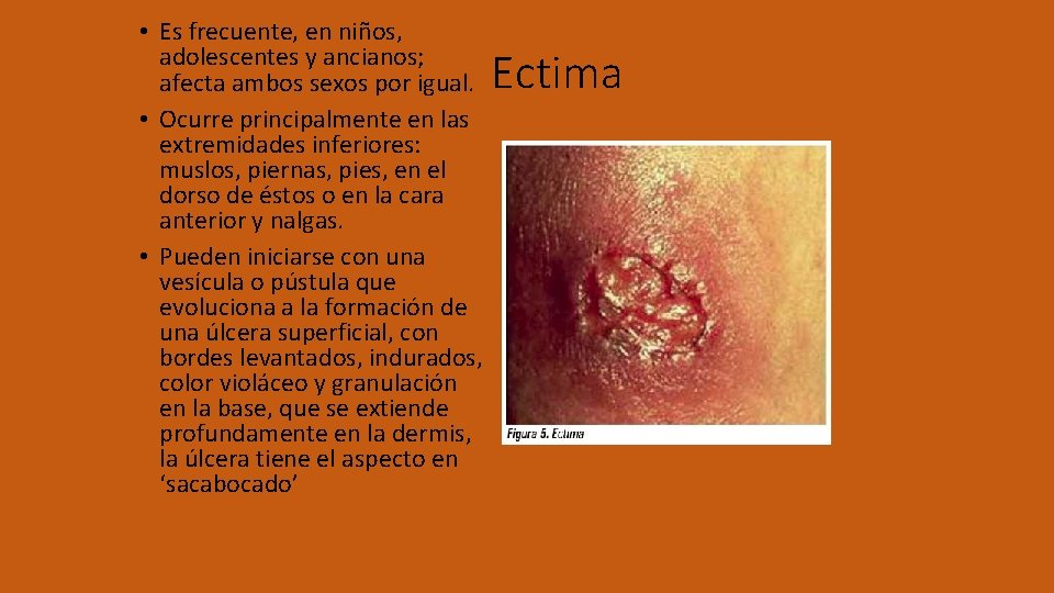  • Es frecuente, en niños, adolescentes y ancianos; afecta ambos sexos por igual.