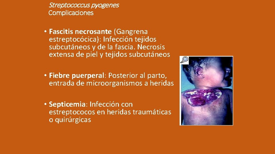 Streptococcus pyogenes Complicaciones • Fascitis necrosante (Gangrena estreptocócica): Infección tejidos subcutáneos y de la